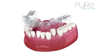 Invisalign at Pure Dental Solutions, Stafford