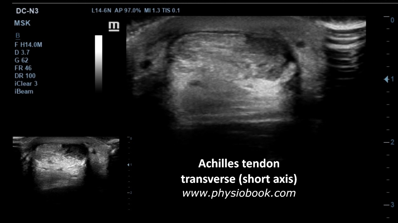 Achilles tendon tear - MSK ultrasound - YouTube