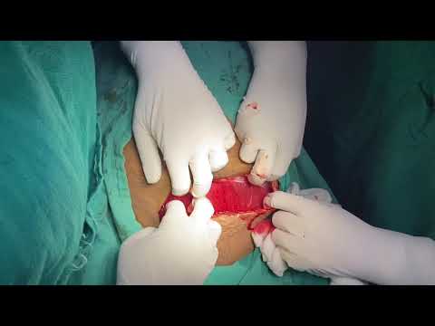 Joel Cohen incision for cesarean section