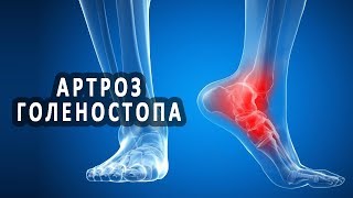 Что нужно знать об артрозе голеностопного сустава Что нужно знать об артрозе голеностопного сустава