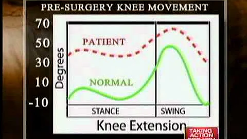 3D exam for Cerebral Palsy