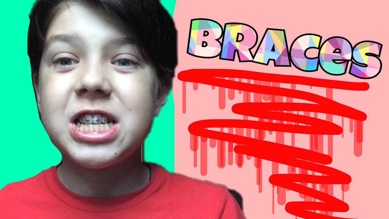 ВСЯ ПРАВДА О БРЕКЕТАХ! МНЕ ПОСТАВИЛИ БРЕКЕТЫ?!1! - YouTube