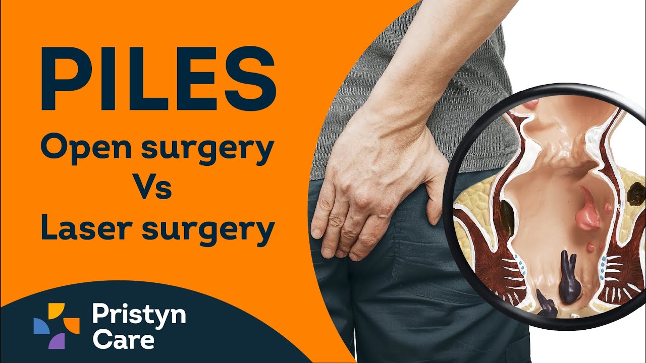 Which Piles Treatment is Better - Open Surgery or Laser Surgery? | Call : 0806-5417-722