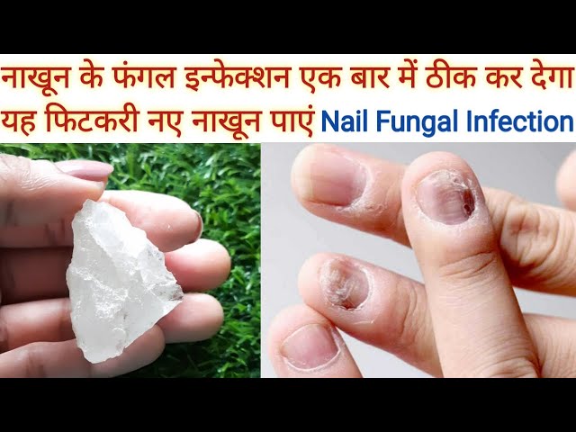 Home remedies for nail fungus | नाखून में लगी फफूंद का घरेलू इलाज: नारियल,  अजवाइन, एलोवेरा जेल से मिलेगी राहत; नाखून चबाने, क्यूटिकल काटने से बचें |  Dainik Bhaskar