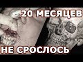 В суд на хирурга? Ортогнатическая операция. 20 мес. спустя.