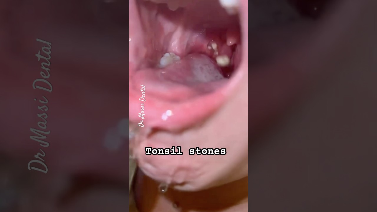 How to remove the Tonsil Stones !