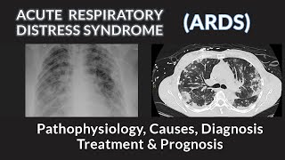 Acute Respiratory Distress Syndrome (ARDS) | Pathophysiology, Causes, Diagnosis and Management