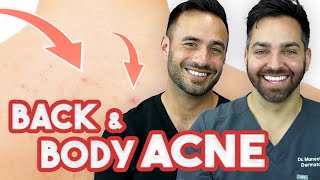 BACK ACNE  How to Treat and Prevent It | Doctorly Routines