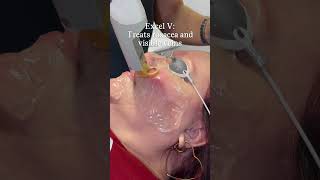 Excel V: Laser for rosacea and visible veins