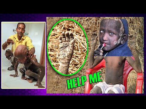 Little Boy Is Turning Into Stone, His Parents Are Calling Out For Help