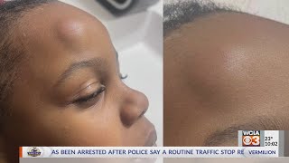 Champaign School District mother upset after child suffered unexplained injury