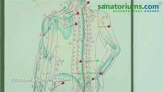 видео Газовые уколы - что это? Показания, противопоказания, отзывы