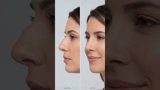 #rhinoplasty #reconstruction #gziroai #plasticsurgery #plasticsurgeon #nosereshaping #aivideo #fyp
