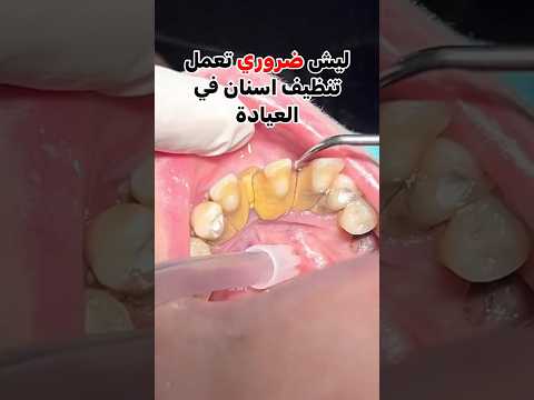 4 اسباب لاهمية تنظيف الاسنان واكيد بنصح اعادة هذا الاجراء كل ٣ ٦ أشهر