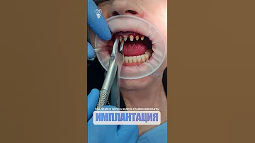 Удаление и через 6 недель ставим импланты. Removal and after 6 weeks we'll put implants.