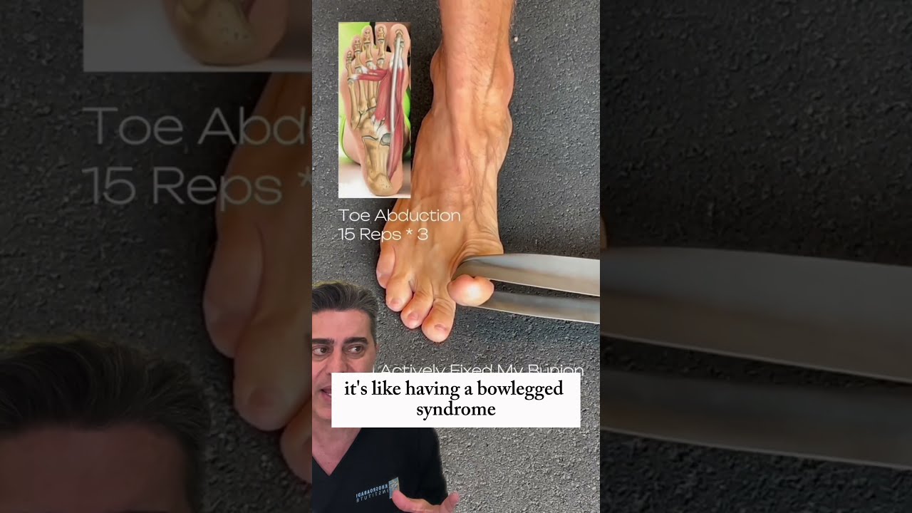 Can You Really Fix Bunions With These Exercises Find Out Now 