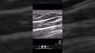 Effects of flush techniques for #doctor and #nurse #vascularaccess #ivinsertion #newgradnurse