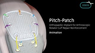 Xiros North America Orthopaedic Implant for Rotator Cuff Repair Reinforcement Animation