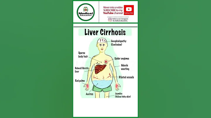 Liver cirrhosis#shorts #medical_education - DayDayNews