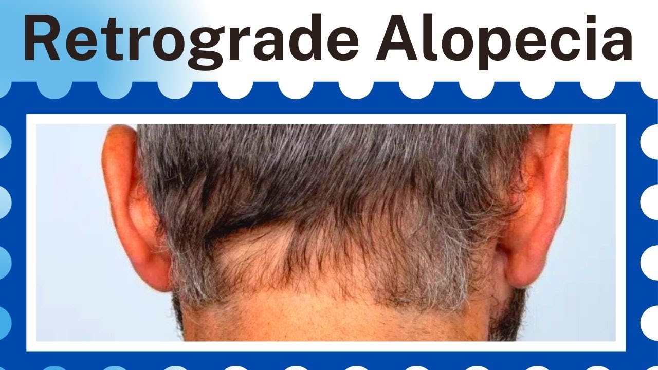 Hair Transplant in Patients with Retrograde Alopecia Bitesize with