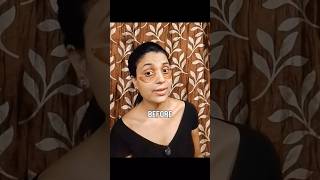dark circle remover patches in just one week #dark #circle#remover#patches #ytshorts#skincare #video