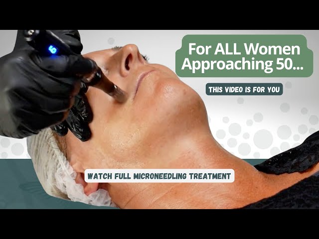 Microneedling Face Treatment | Full step by step guide - 2021