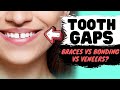 Close Gaps Between Teeth | Black Triangles SOLUTIONS