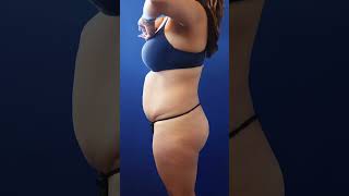 2 months after tummy tuck with 360 liposuction by Dr. Erick Sanchez in Baton Rouge, LA