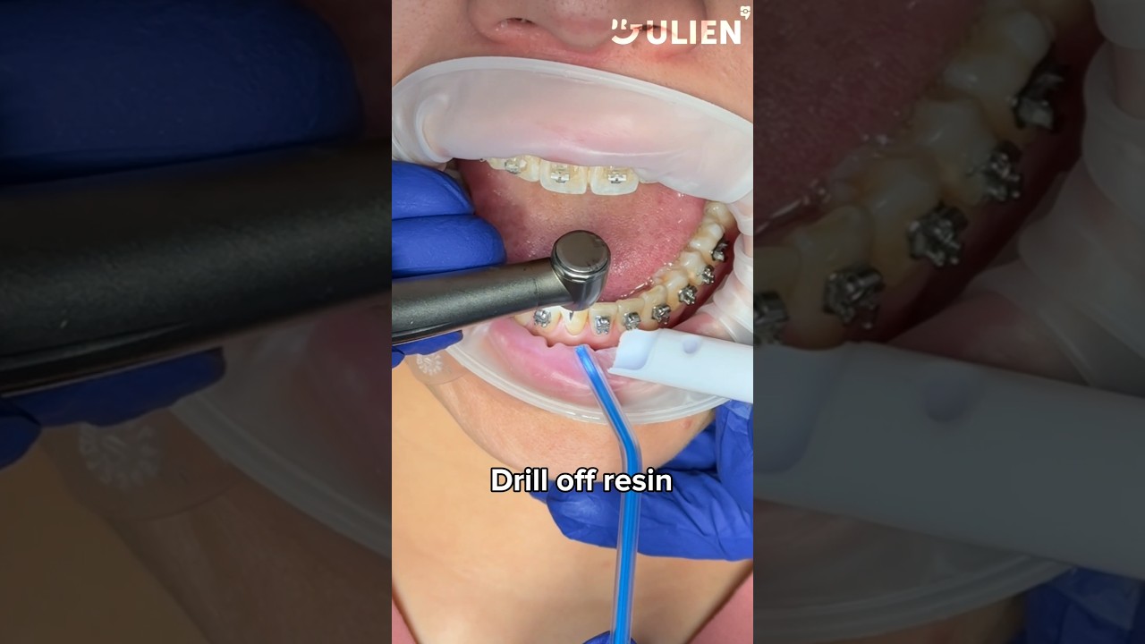 This is How We Fix Your Broken Bracket 