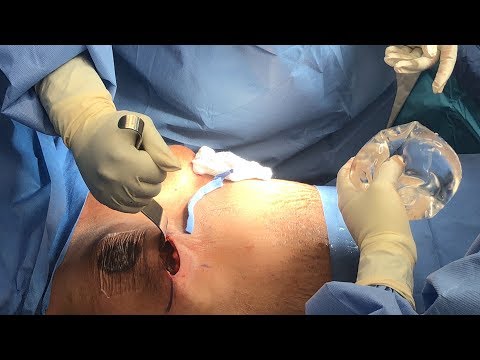 Video: Nagsalita Ang Plastic Surgeon Na Si Irina Konstantinova Tungkol Sa Mga Intricacies Ng Operasyon Sa Pagpapalaki Ng Suso