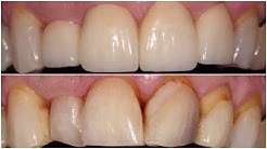 Mark - Cosmetic Crowns & Veneers - Austin General Dentistry 