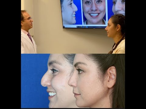 Video thumbnail: Entire Rhinoplasty Journey from day of surgery to 3 months after surgery! · Ali Sajjadian