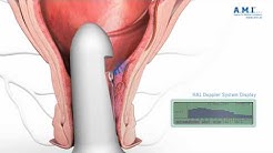 Hämorrhoiden Gummibandligatur Nebenwirkungen - arzt für ...