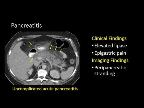 Iga Pancreatitis
