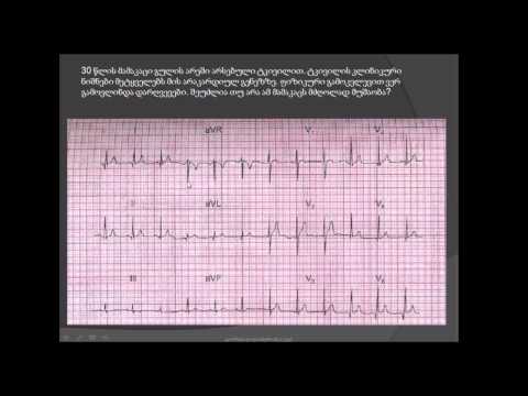 ეკგ- მძღოლი გულის არეში ტკივილით/ გულის არეში ჩხვლეტა / ECG / EKG