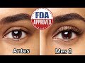 Bimatoprost Para Pestañas, Cejas Y Alopecia