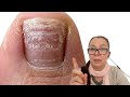 Strange texture on her toenails [Pro Nail Technician explains]