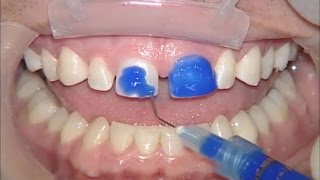 No Prep Veneers with Prismatik ThinPress™