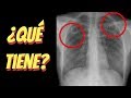 5 casos clínicos de radiografía de tórax