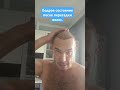 Пересадка волос / Самочувствие после процедуры #пересадкаволосмосква
