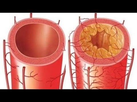 Единственный способ чистки сосудов (артерий и вен)