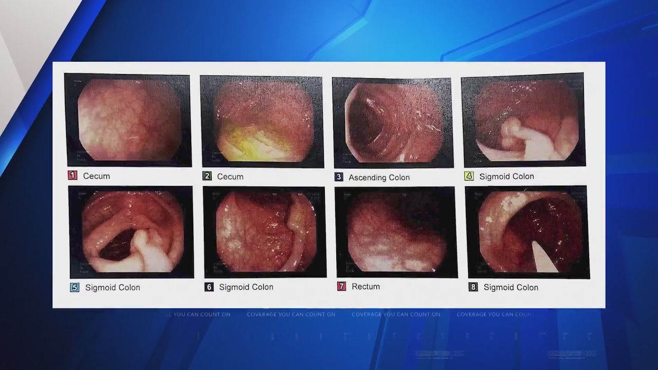 St Louis Doctors Been Telling Patients To Get Colonoscopy By Age 45