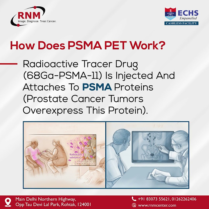 prostate-cancer-psma-pet-ct-scan-is-an-imaging-test-used-to-detect