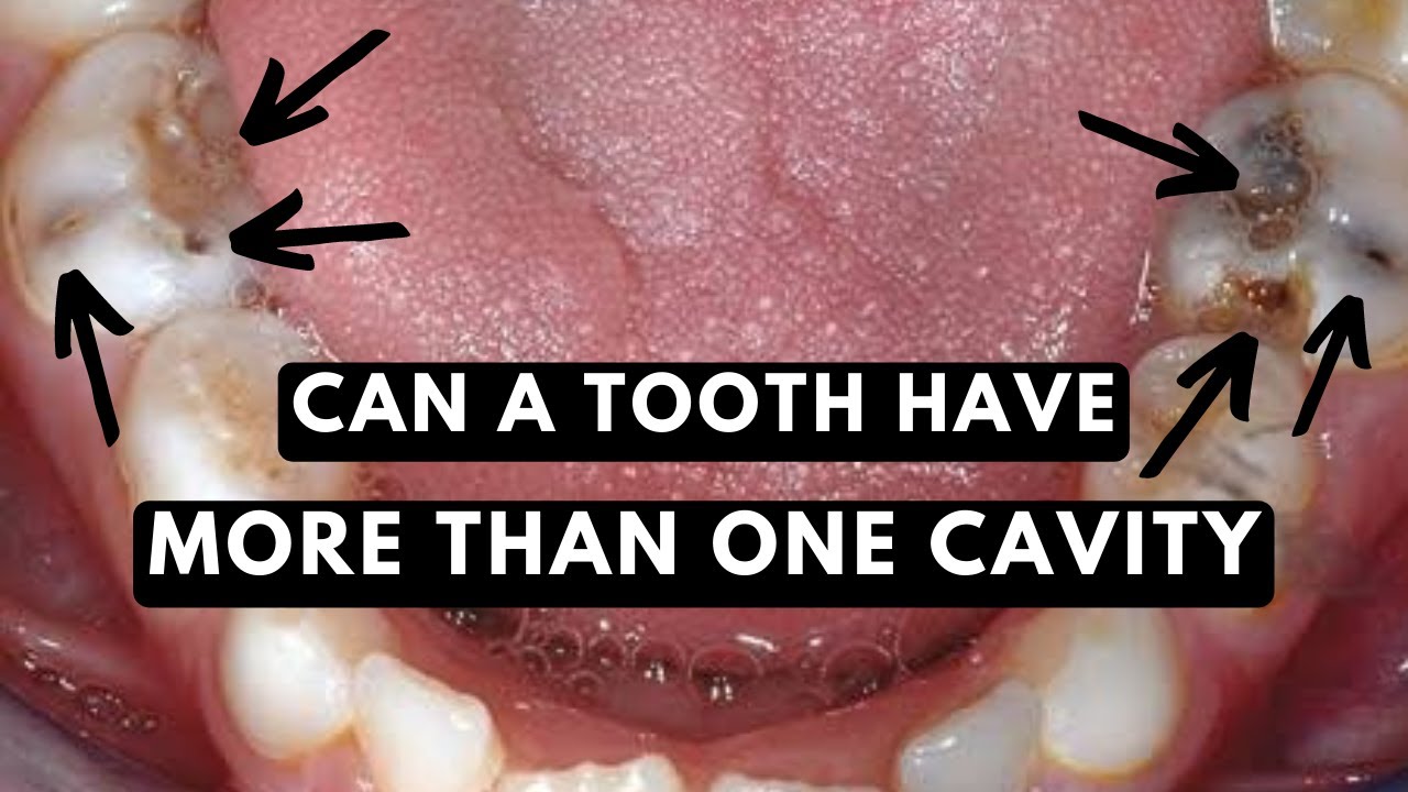 Tooth Only One TOOTH CAVITY | Can a single tooth have more than one? - YouTube