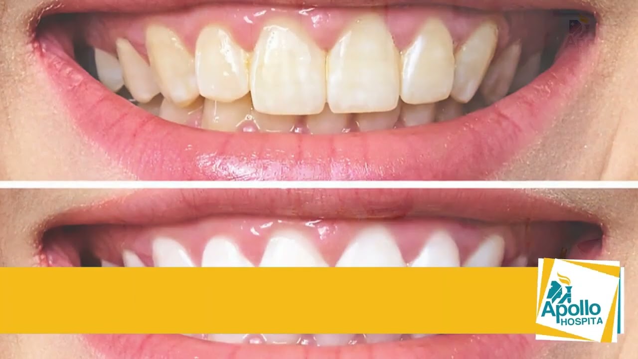 How to Whiten teeth    How to Remove Brown Stained on Teeth   Daant Saaf Karne ka Tarika