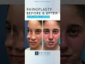 Six Weeks After Rhinoplasty 👃💖 | Bridge Hump Refined with Dr. Becker