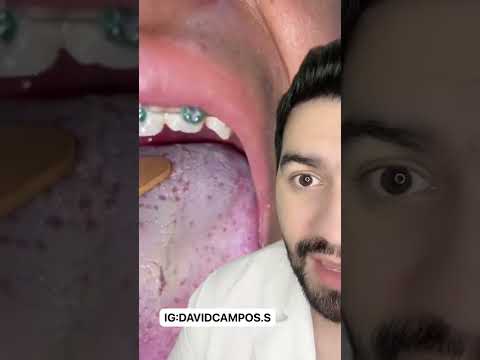 Video: ¿La amigdalitis desaparece?