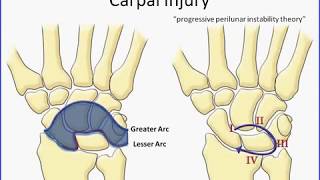 Carpal Instabilities HD [Basic Radiology]