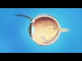 Macular Hole: Vitrectomy Surgery