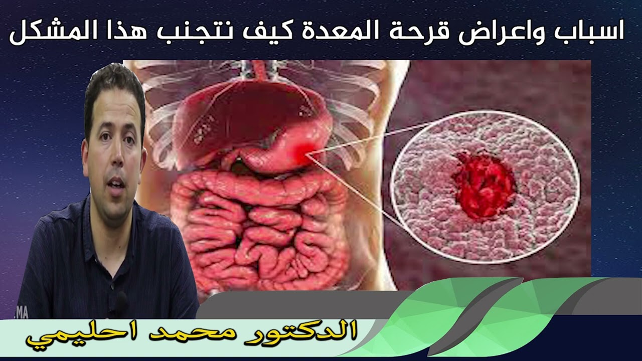 اسباب واعراض قرحة المعدة كيف نتجنب هذا المشكل الدكتور محمد احليمي